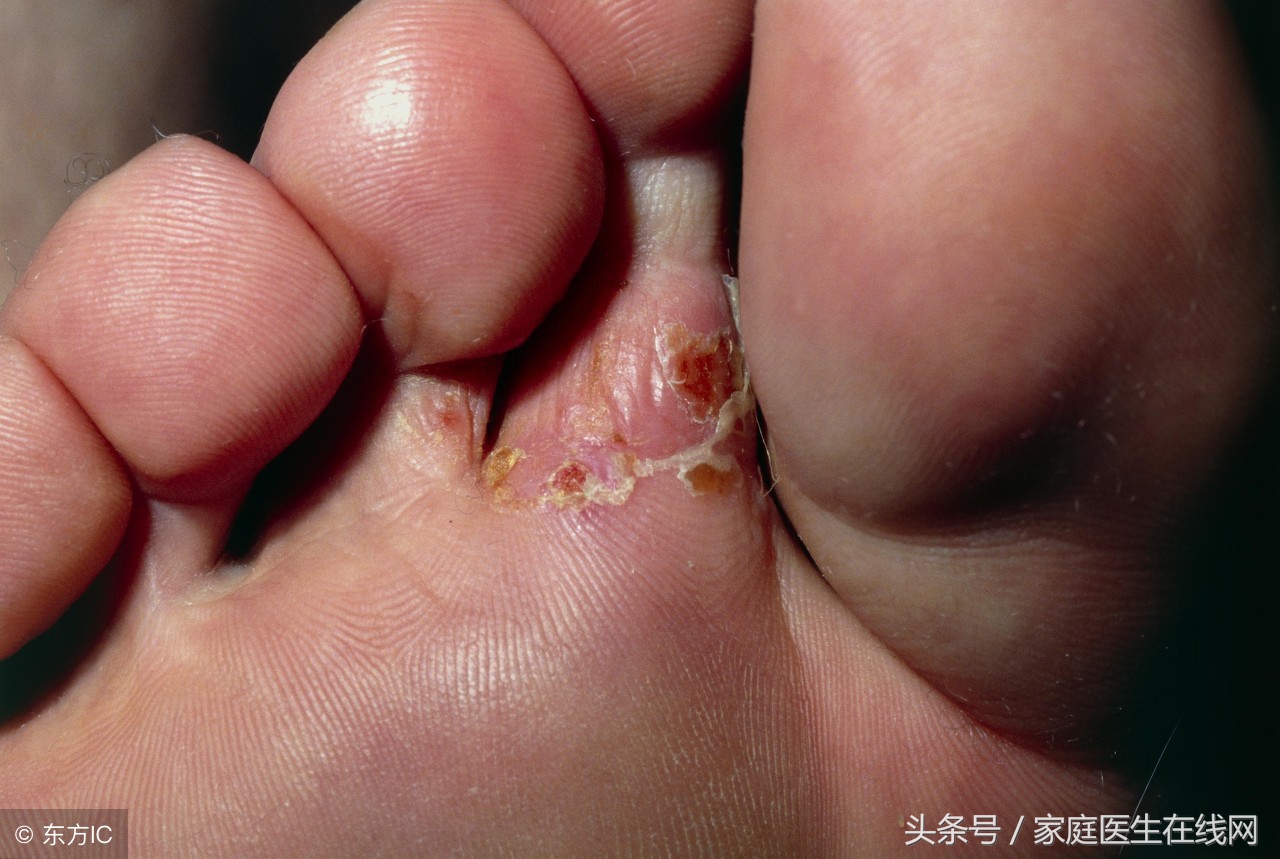 脚气能根除吗严重的脚气怎么治疗,日本脚气水可以根治脚气嘛