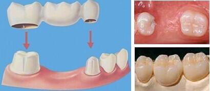 缺了牙齿不补会怎么样,缺了一颗牙齿不种牙矫正可以吗