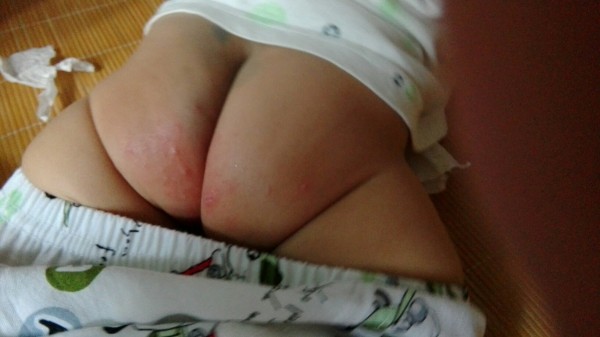 宝宝穿纸尿裤红肿怎么回事,宝宝用纸尿裤起水泡破皮怎么办