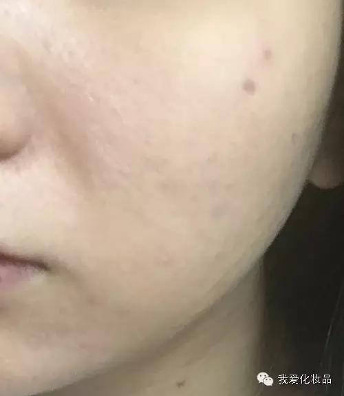 油皮痘肌适合的护肤品牌子,混油皮痘肌适用的护肤品推荐