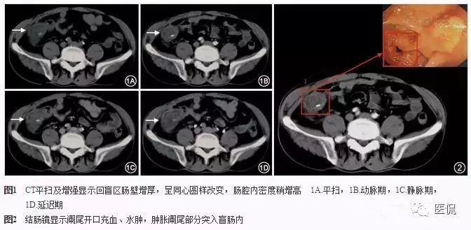 阑尾的解剖和影像表现,阑尾炎的32种鉴别诊断