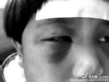 小女孩被妈打的眼睛淤青,女童眼袋黑眼圈重