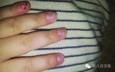 宝宝经常吃手指怎么办,宝宝总是喜欢吃手指啃指甲怎么办