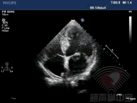 二尖瓣充血性囊肿,二尖瓣血性囊肿是什么意思