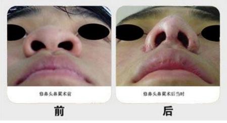 哪些人适合鼻尖整形呢,什么人适合做鼻翼