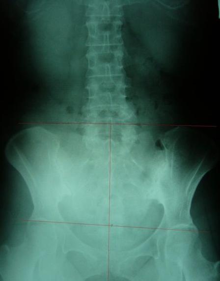 屁股歪了,屁股歪了最佳治疗方法