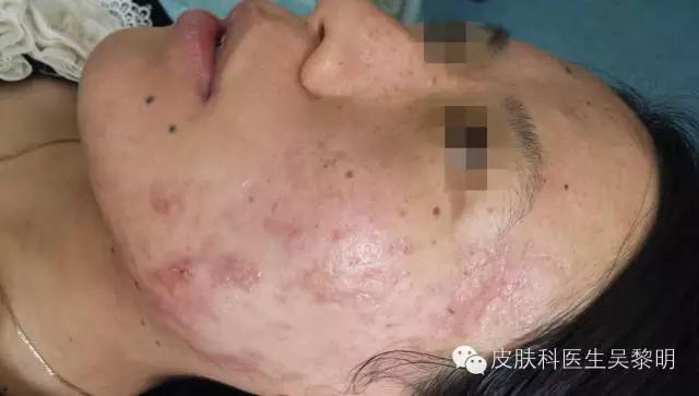 透明质酸护肤品功效,透明质酸是修复皮肤敏感成分