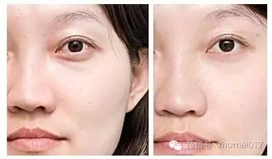 脸上部分凹陷,年龄增长脸颊凹陷