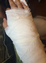 石膏固定的目的及注意事项,石膏固定后注意事项