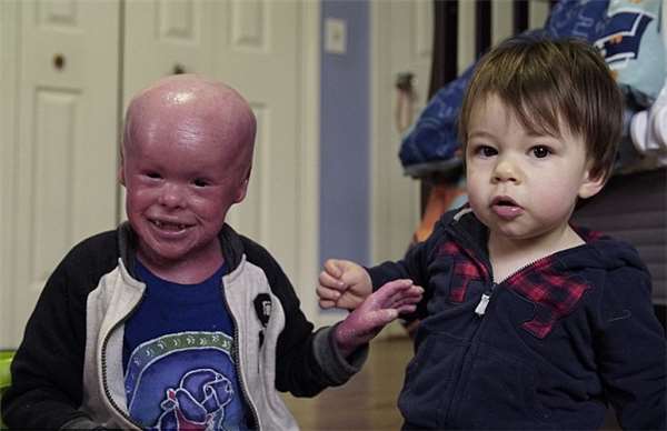 孩子刚出生就满身鱼鳞,孩子生下来身上全是鱼鳞