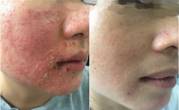 激素依赖性皮炎怎么治疗好得快,严重的激素依赖性皮炎怎么治疗