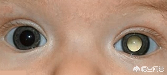 夺去王凤雅小朋友生命的视网膜母细胞瘤能治愈吗？