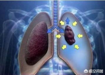 肺大泡不可以用力屏气不能提拉重物,可能导致其增大甚至破裂