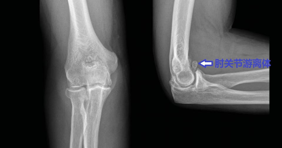20年前肘关节伸不直,肘关节手术失败十几年伸不直