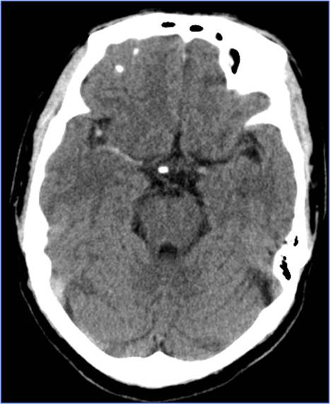 缺血性脑卒中术后管理,急性缺血性脑卒中血管内治疗