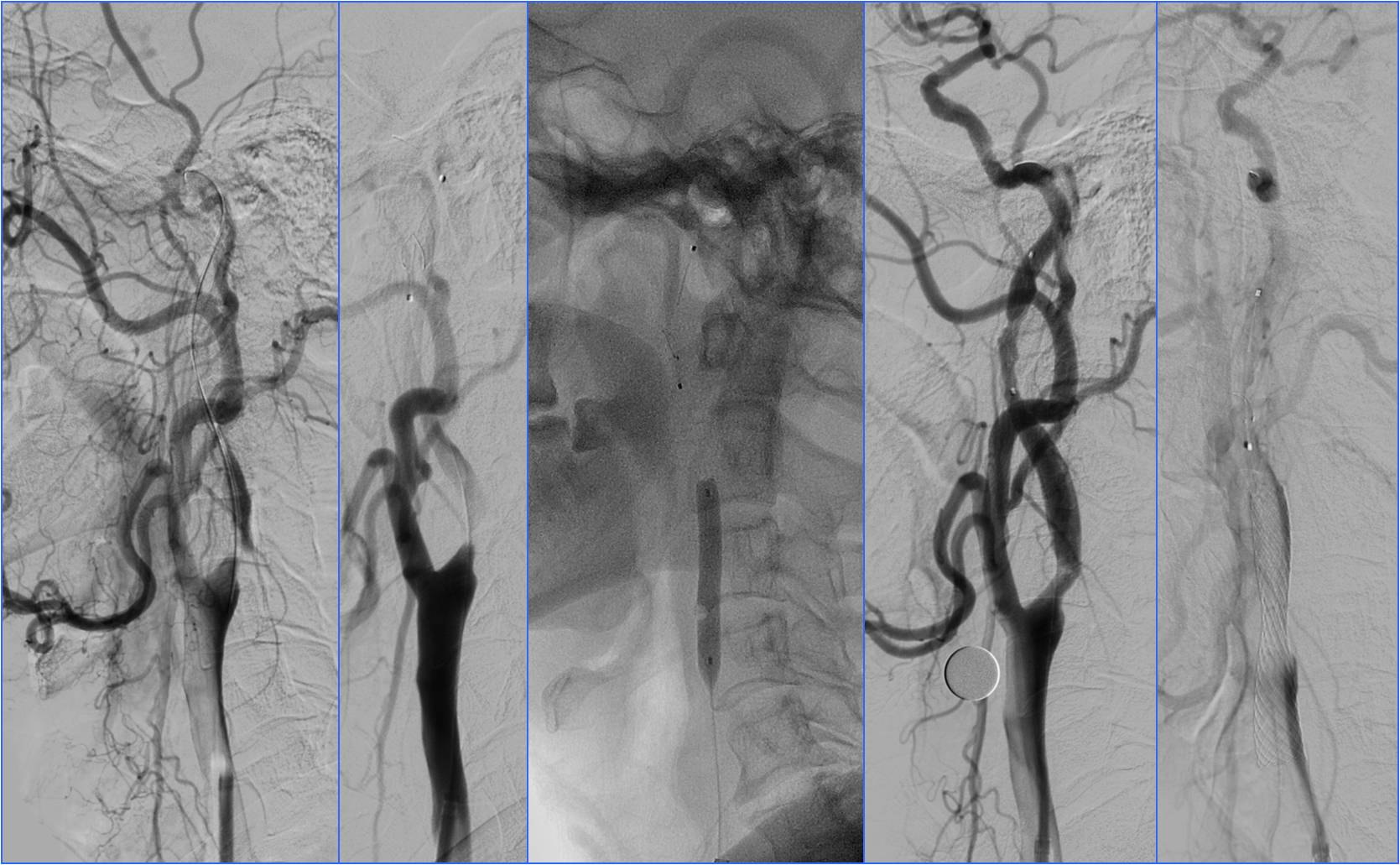 缺血性脑卒中术后管理,急性缺血性脑卒中血管内治疗