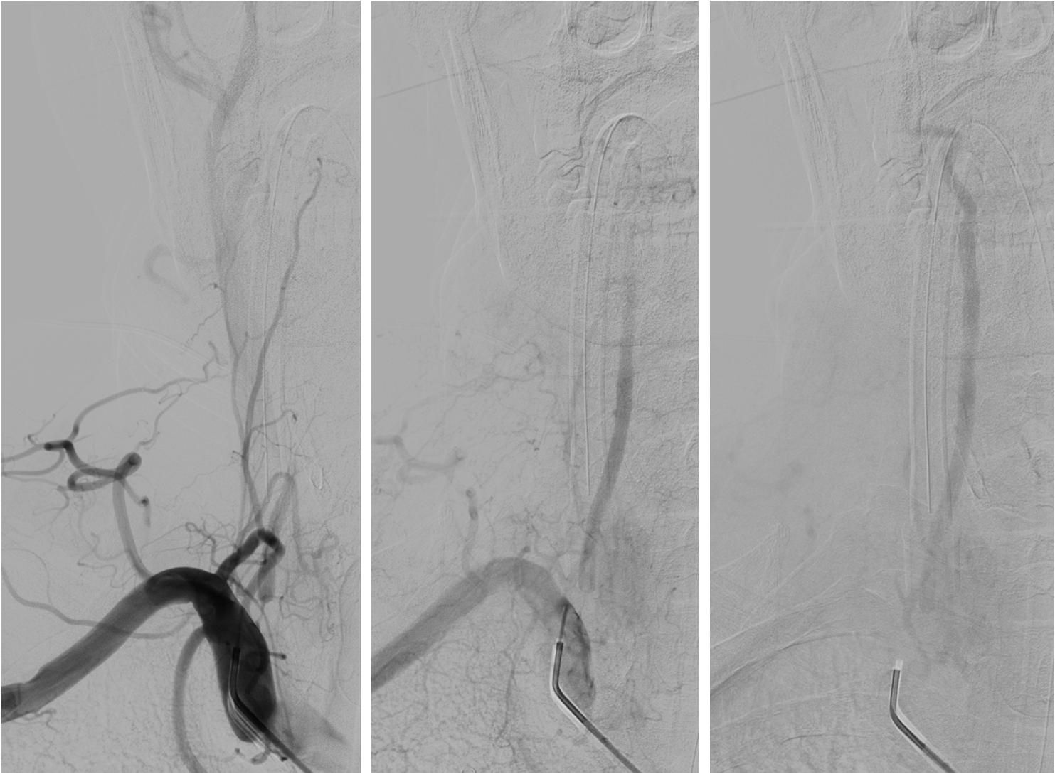 缺血性脑卒中术后管理,急性缺血性脑卒中血管内治疗