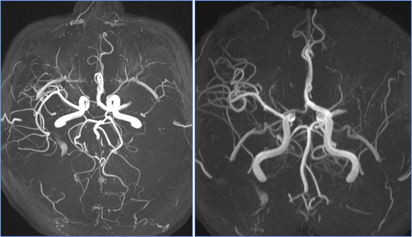 缺血性脑卒中术后管理,急性缺血性脑卒中血管内治疗