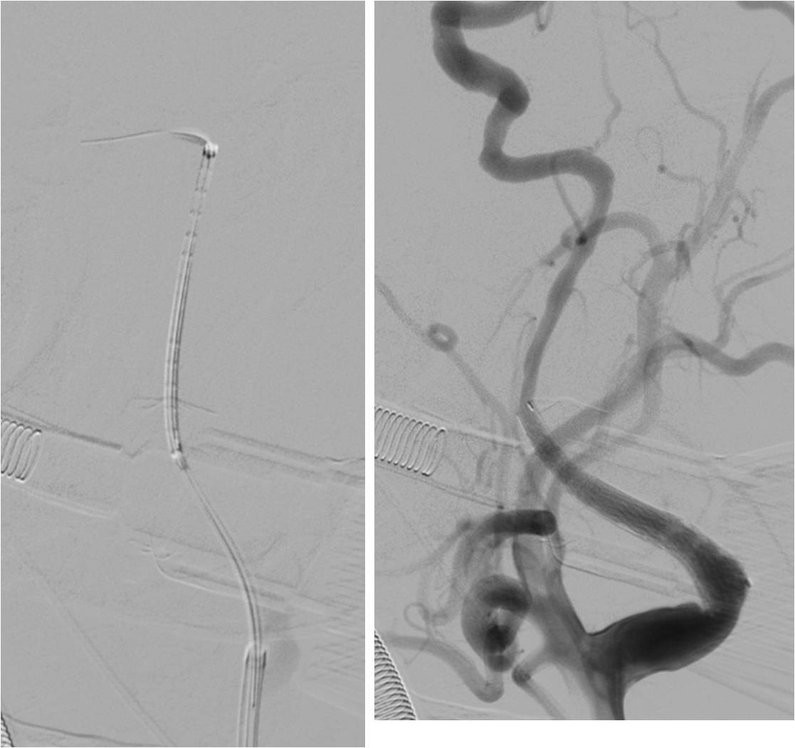 急性缺血性脑卒中血管内治疗,缺血性脑血管病的抗血小板药治疗