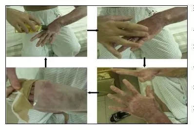 selina烧伤治疗过程,selina烧伤的皮肤恢复好了吗