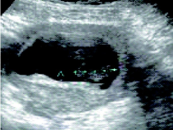 急症查流产征兆,医学检查流产