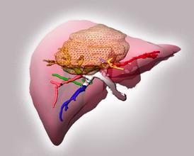 小肝癌手术后会不复发吗,肝癌手术后复发怎么治疗