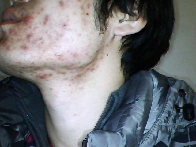 下巴长痘痘怎么调理排毒祛痘,下巴周围长痘痘能吃中药调理吗