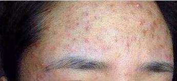 额头下巴长痘痘的原因和解决方法,额头长痘痘的原因和解决方法