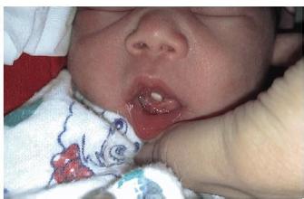 刚出生的婴儿长牙齿怎么处理,120天的宝宝长牙齿