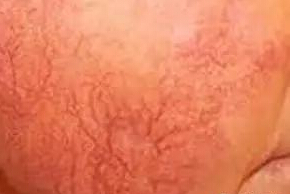 怎样增厚角质层增强皮肤免疫力,吃什么增厚脸上皮肤角质层