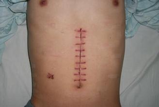 切口愈合发痒是怎么回事？该怎么办？