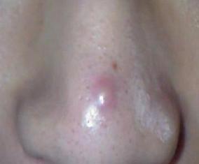 治青春痘最有效的方法,怎样治青春痘比较好