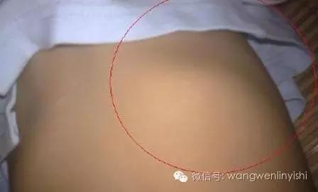 肋弓外翻是什么意思,肋弓外翻能矫正吗