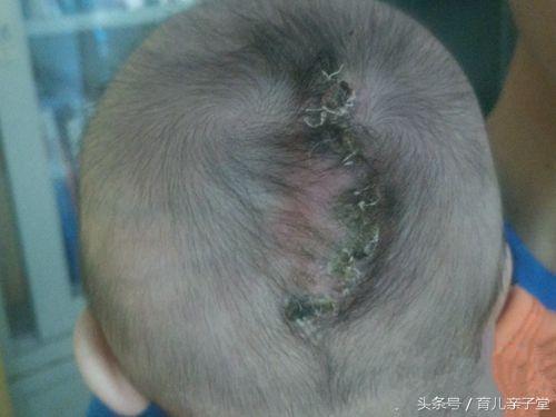 初生女婴头上长肉瘤，四月时长有两“脑袋”！