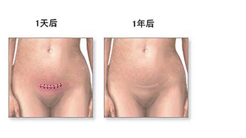 剖腹产没有想象中的那么可怕,剖腹产手术中的真实感受