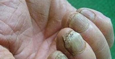 灰指甲是什么?哇，一看也吓一跳，危害这么多