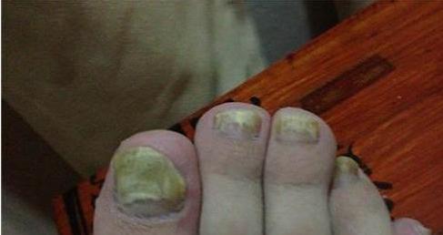 各种灰指甲问题看过来,灰指甲的真菌进入血液有危害吗