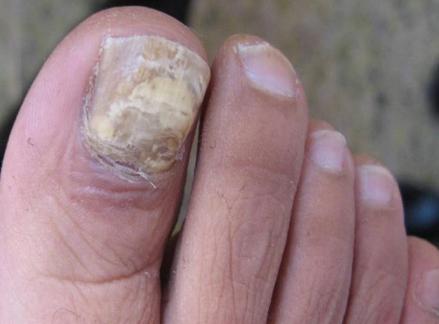 各种灰指甲问题看过来,灰指甲的真菌进入血液有危害吗