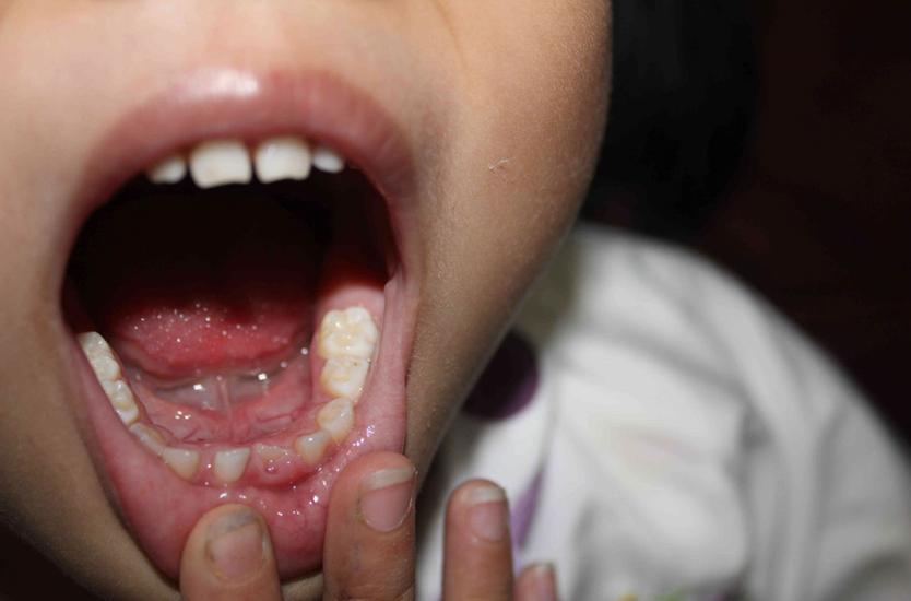 4岁小孩子牙齿烂了怎么处理,满口牙齿全部烂了