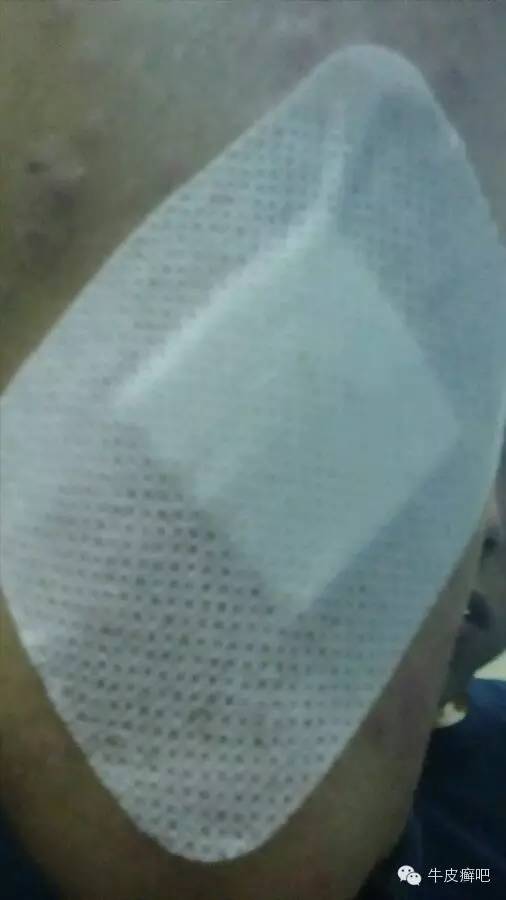 医院专家教你治疗牛皮癣,专家专治牛皮癣方法