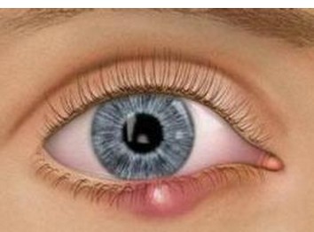 宝宝针眼用什么药,两岁宝宝长针眼怎么治疗