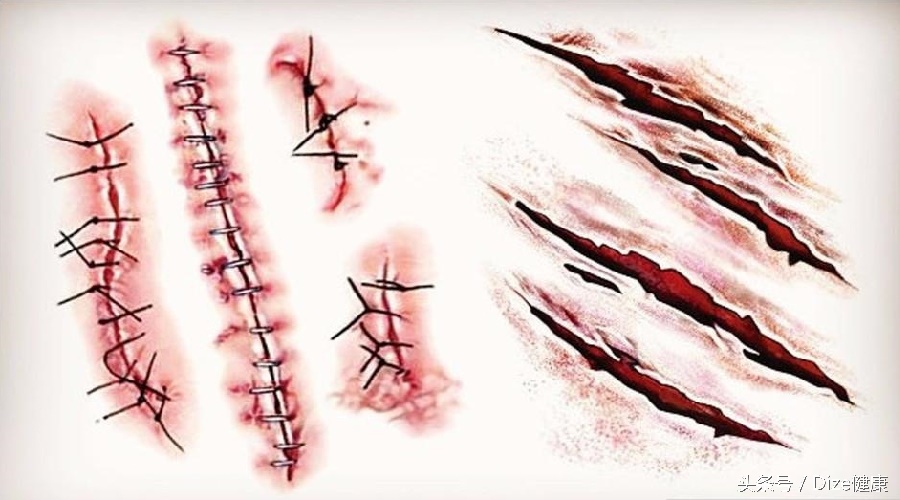 如何防止疤痕形成的小妙招,如何避免疤痕留印