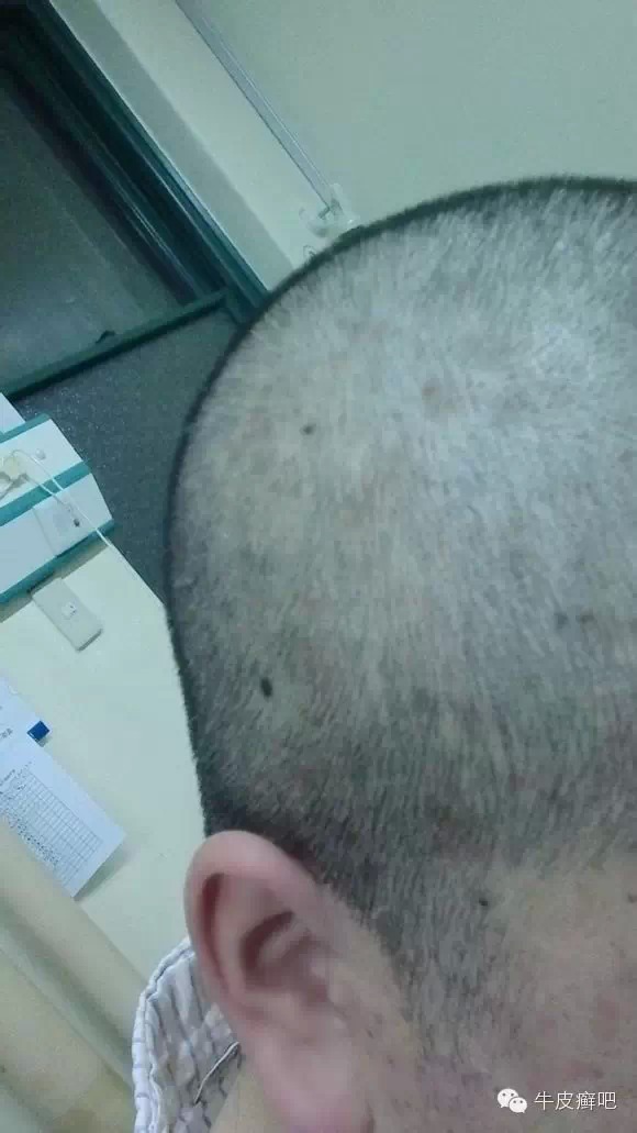 医院专家教你治疗牛皮癣,专家专治牛皮癣方法