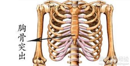 小孩鸡胸咋治愈,小孩鸡胸怎么干预