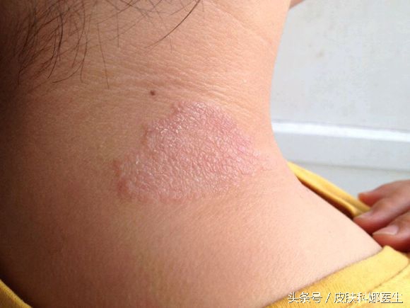 上眼皮神经性皮炎痒怎么办,两个眼皮痒是神经性皮炎吗