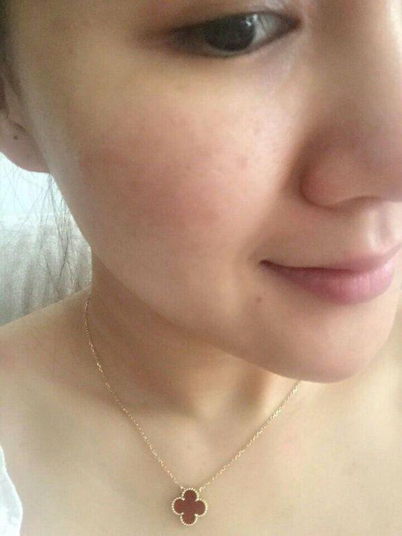 脖子上的痘痘反复发作,一个地方痘痘反复发作