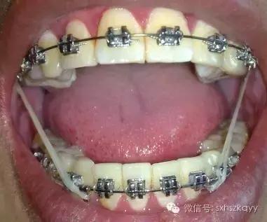常见排齐牙齿的四大方法,牙齿拥挤重叠矫正过程