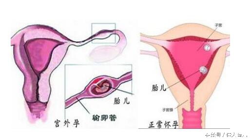 女子吃避孕药发生宫外孕,紧急避孕导致宫外孕的几率有多大