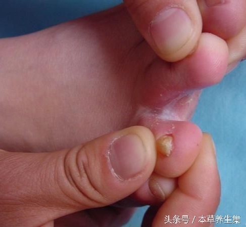 脚水泡又痒又脱皮糜烂怎么引起的,趾间糜烂型脚气可以用足光散吗