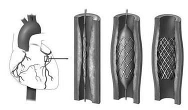 心脏支架手术和搭桥哪个风险大,心脏支架可能的风险